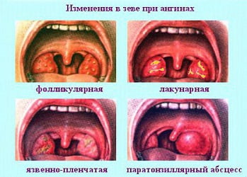  разновидности ангины