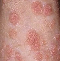 Баланопостит у мужчин 2