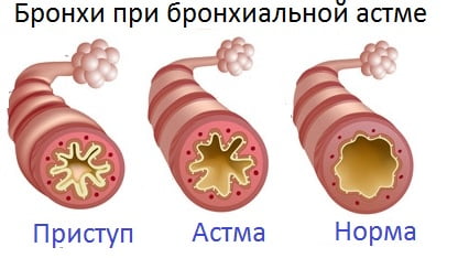 Бронхиальная астма 2