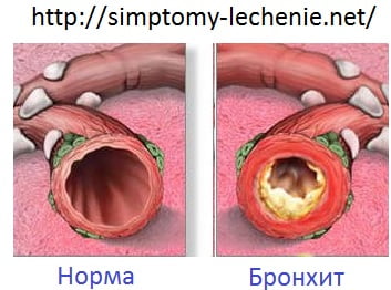 Бронхит 3