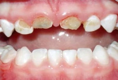 Бутылочный кариес