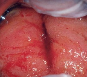 Цервицит лечение