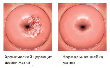 Цервицит причины