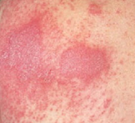 Дерматит лечение