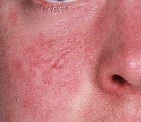 Фото дерматита на лице