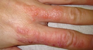Дисгидротическая экзема на пальце