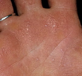 Дисгидротическая экзема на руках