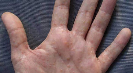 Дисгидротическая экзема