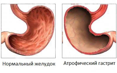 Гастрит атрофический