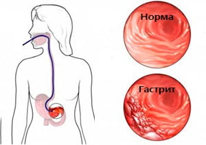 Гастрит диагностика