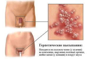 Генитальный герпес у мужчин и женщин