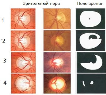 Глаукома стадии