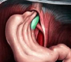 Грыжа пищевода