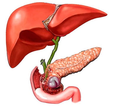 Холецистит причины
