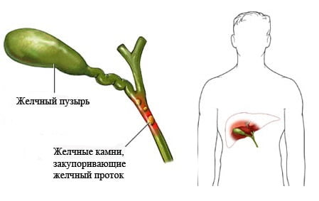 Холецистит симптомы