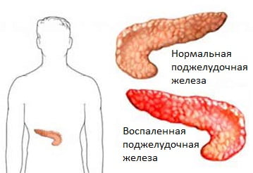 Хронический панкреатит причины