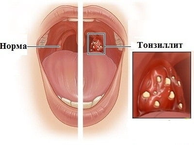 Хронический тонзиллит признаки