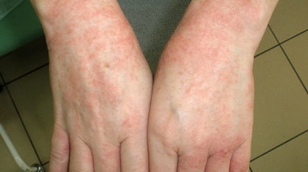 Экзема лечение