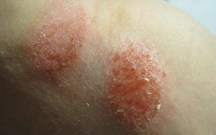 Экзема признаки