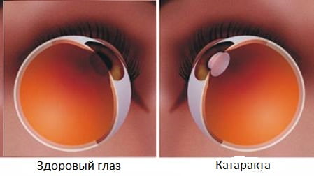 Катаракта и хрусталик