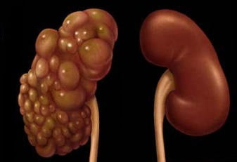 Киста почки причины