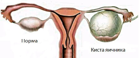 Киста яичника симптомы