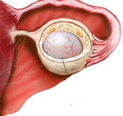 Киста яичника