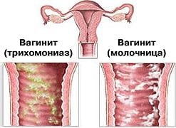 Кольпит у женщин