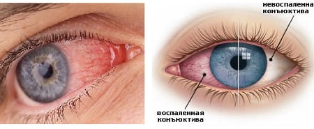 Конъюнктивит 2