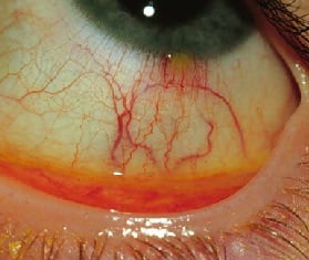 Конъюнктивит симптомы