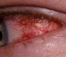 Конъюнктивит