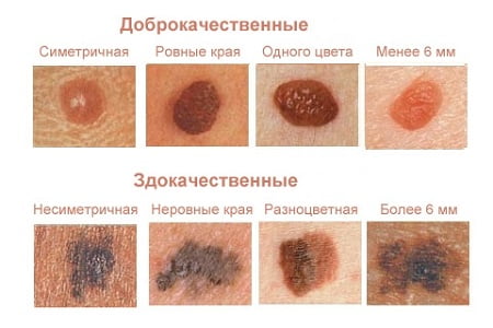Красные родинки классификация