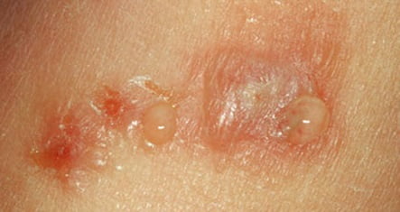 Мокнущая экзема признаки
