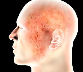 Мокнущая экзема