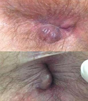 Начальная стадия геморроя