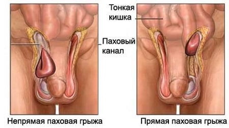 Паховая грыжа причины