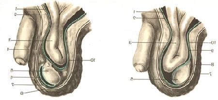 Паховая грыжа признаки