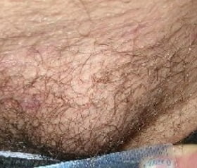 Паховая грыжа у мужчин