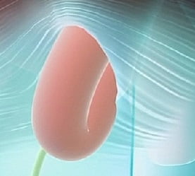 Паховая грыжа