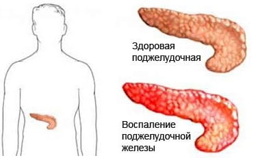 Панкреатит причины