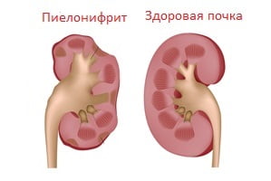 Пиелонефрит признаки