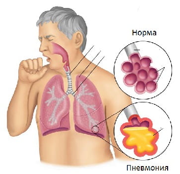 Пневмония симптомы