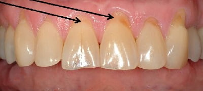 Прикорневой кариес