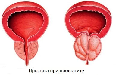Простатит симптомы
