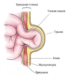 Пупочная грыжа причины