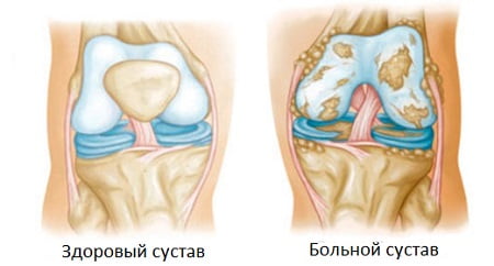 Реактивный артрит лечение