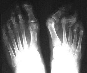 Реактивный артрит симптомы