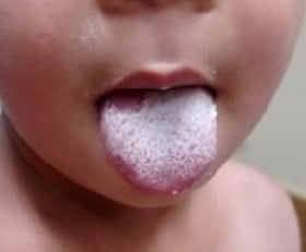 Скарлатина лечение