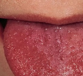 Скарлатина у детей