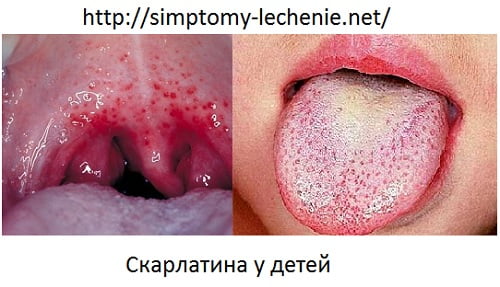 Скарлатина